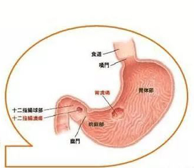 胃溃疡,关于这一常见疾病的详解与关注