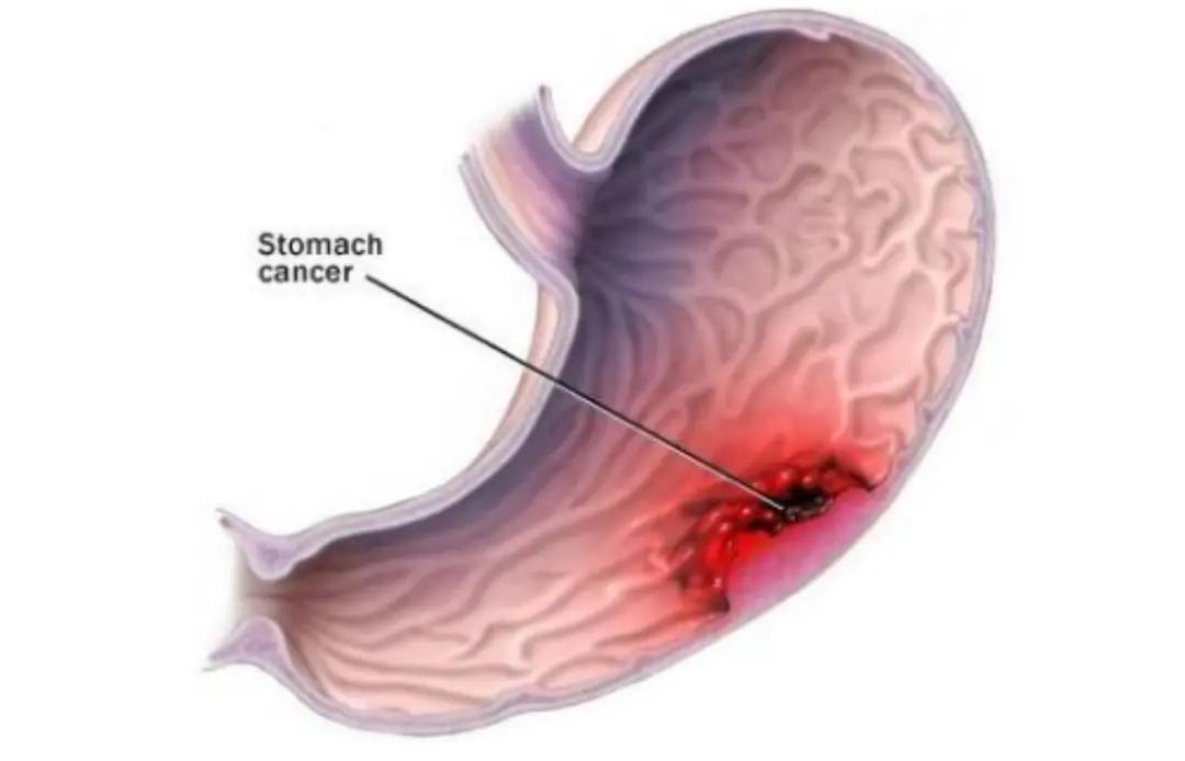 胃溃疡,关于这一常见疾病的详解与关注