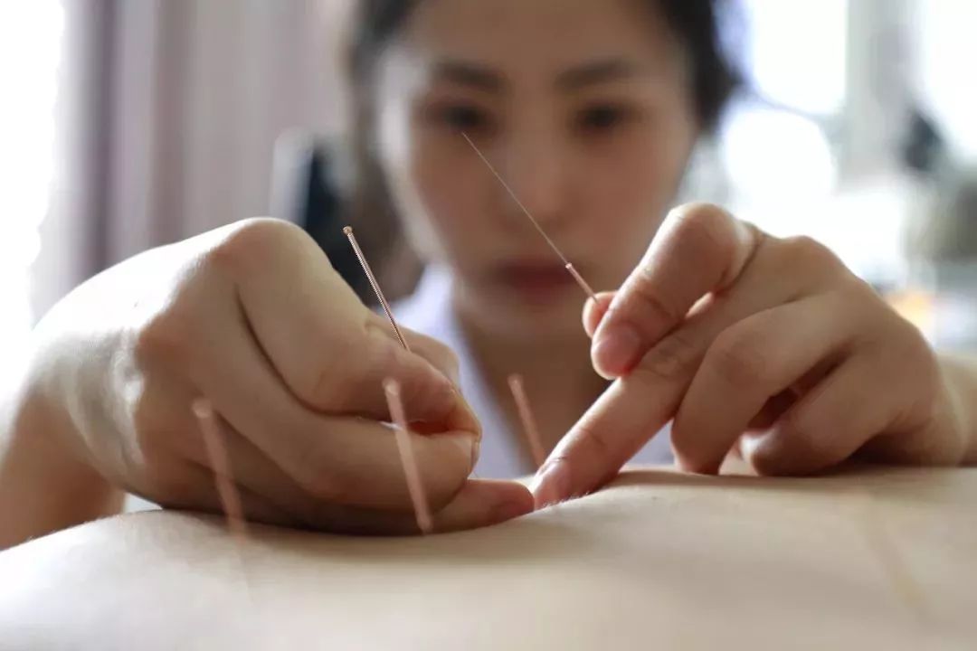 针灸,解锁身体能量,重塑健康之美