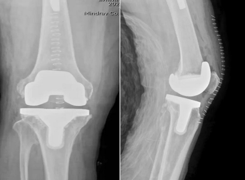 人工关节植入步骤指南