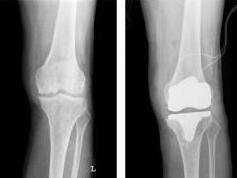 人工关节植入步骤指南